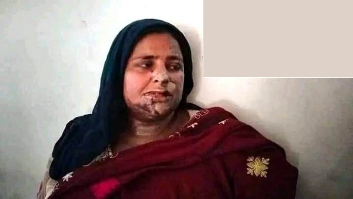Acid victim Farzana